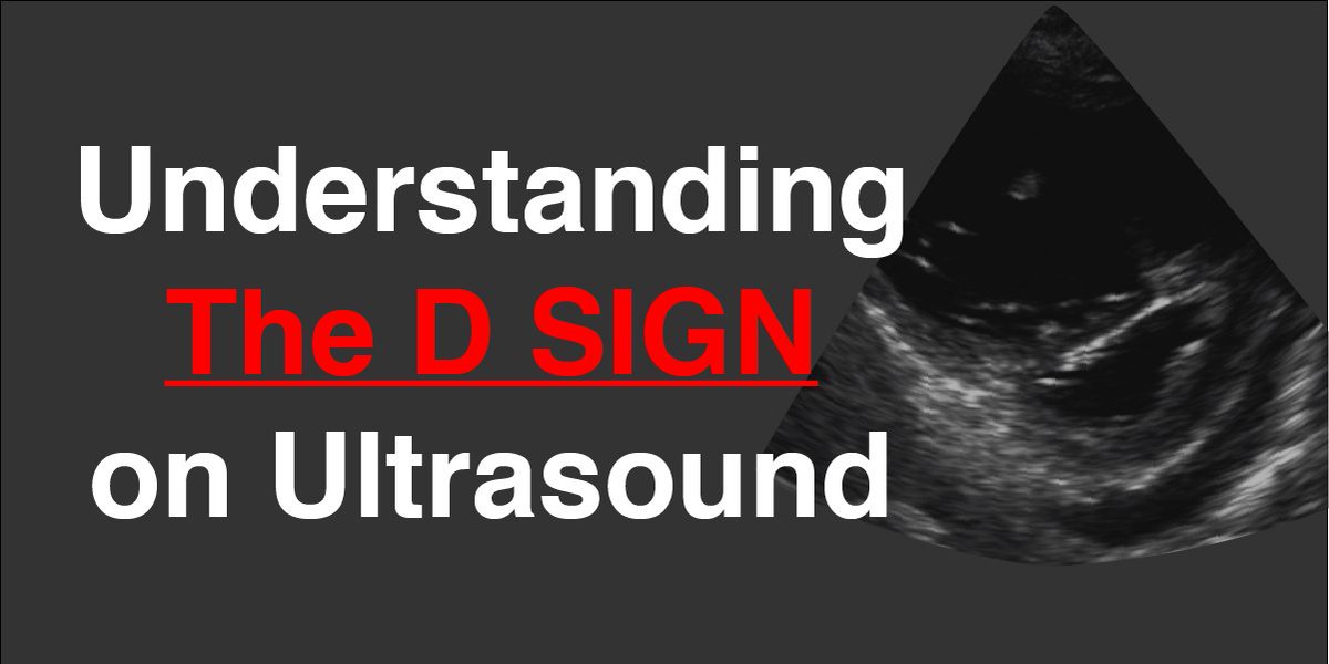 Pocus101's tweet image. Now You May Have Heard of the &quot;D Sign&quot; on Ultrasound. 

But do you know how to Differentiate between ♨️Pressure vs 🥤Volume Overload using the D Sign and the Eccentricity Index? 

New Blog Post! Download #POCUS Pocket Guide PDF:
👉🔗Pocus101.com/D-Sign

#medtweetorial👇(1/9)