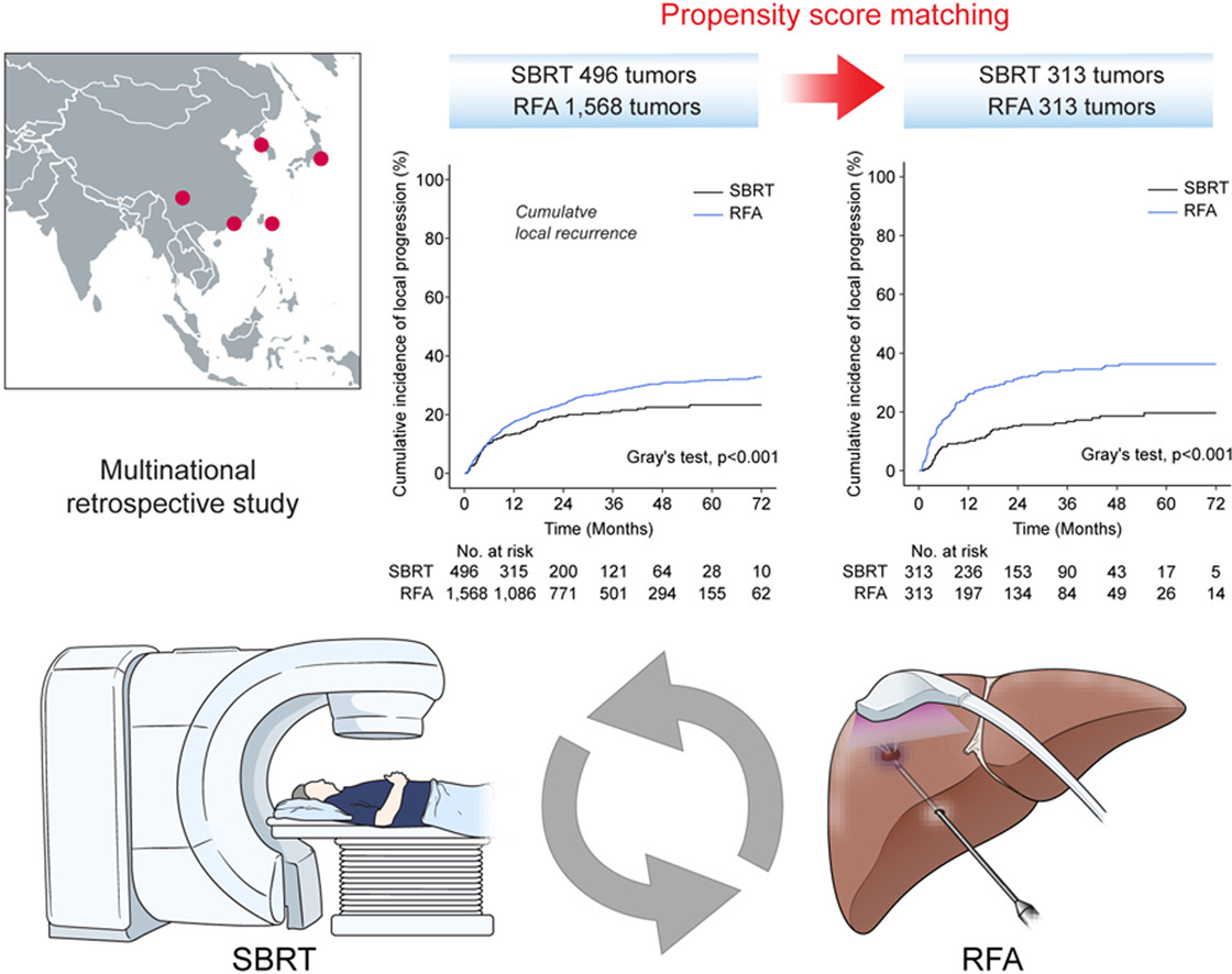JHepatology's tweet photo. Stereotactic body radiation therapy could be an effective alternative to radiofrequency ablation for #unresectable #HCC, particularly for large subphrenic tumors

Read at https://t.co/VEPEVoKzDf

Linked Editorial at https://t.co/oCTRGjI9Zj https://t.co/yANkUUnw1e