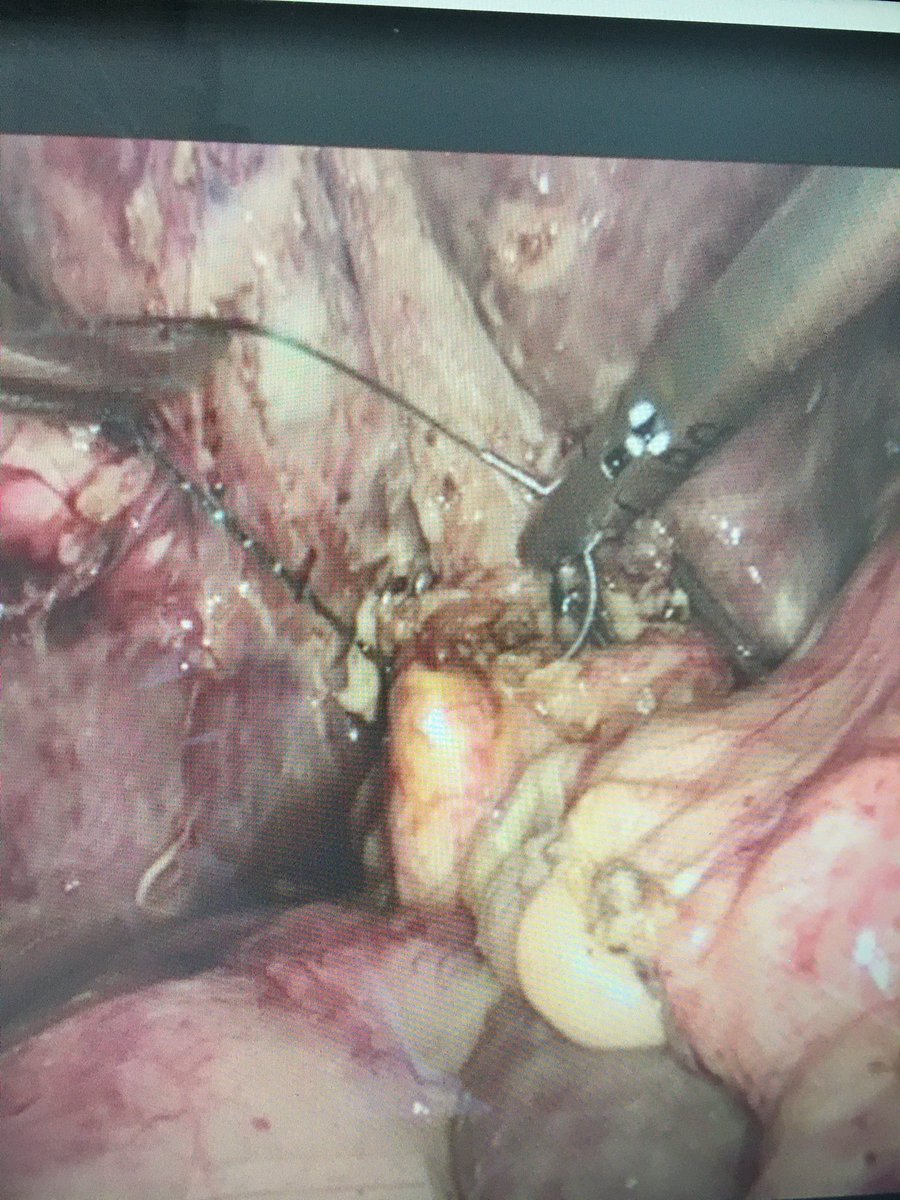 @Cirbosque @PipeCabreraV @salo75 @juliomayol @SWexner @pferrada1 @MISIRG1 @almagoch @DrJonnys @FitSurgeon @DissanaikeMD @TopKniFe_B @obesesurgery LC+LCBDE, using a videocholedochoscope and Dormia basket. In selected cases, closure with barbed suture