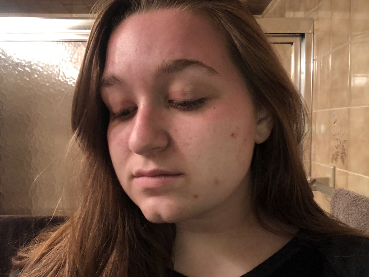 saam_brownn's tweet photo. I walked at my local park and played badminton in my backyard today and I have sunburn.
I have a sunburn that is only on the part of my face that was out of my mask. (I’m not perfect I have acne but this is too funny not to share) #firstburnoftheyear https://t.co/IYGOvETaW2