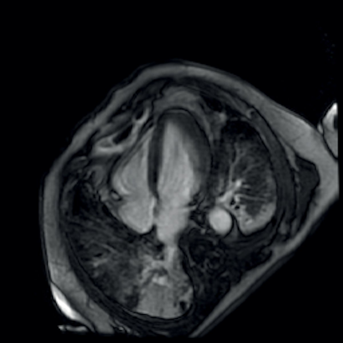 CMR paper 5 – Doyen D et al.DOI – 10.1016/S0140-6736(20)30912-0Age – 69Sex – MTroponin – 9002 ng/LLVEF – Normal on echoLGE – Subepicardial in the inferolateral wall and apexT1 – Not mentionedT2 – Not mentionedCardiac pathology – None