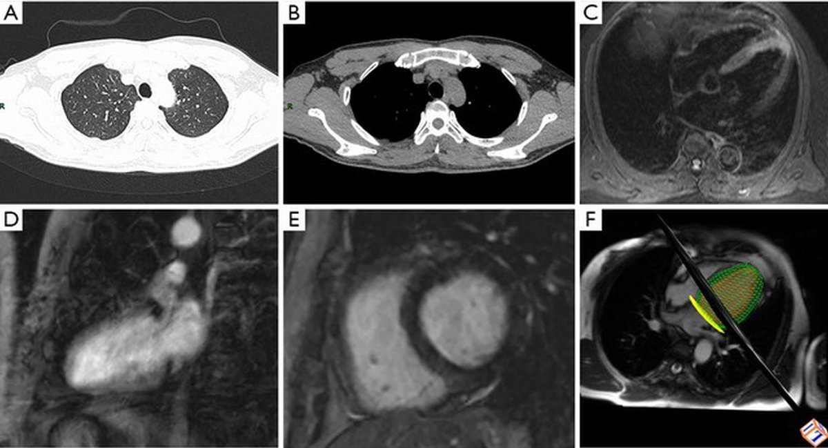 CMR paper 2 – Yuan WF et al.DOI – 10.21037/cdt.2020.03.08Age – 33Sex – MTroponin – Not mentionedLVEF – Slightly decreasedLGE – NoneT1 – Not mentionedT2 – ElevatedCardiac pathology – None