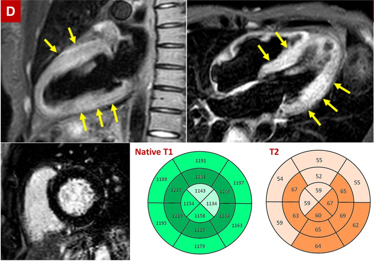 CMR paper 3 – Sala S et al.DOI – 10.1093/eurheartj/ehaa286Age – 43Sex – FTroponin – 135 ng/LLVEF – 64%LGE – NoneT1 – ElevatedT2 – ElevatedCardiac pathology – Diffuse T-lymphocytic infiltrates, edema, limited necrosis. No SARS-CoV-2 genome in the myocardium