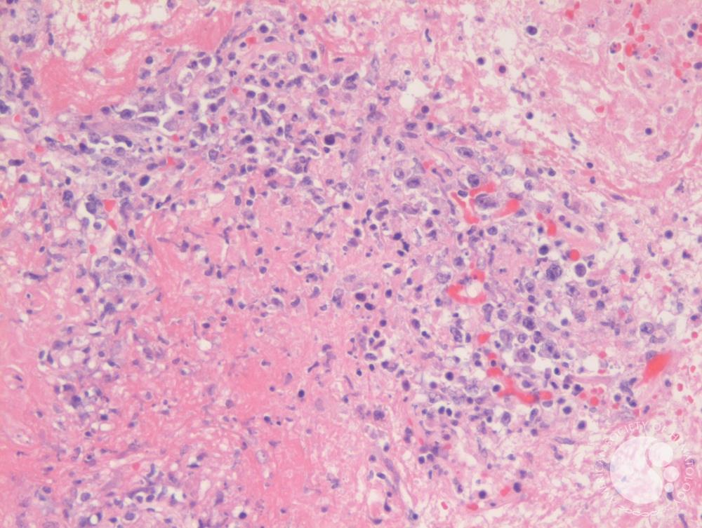 Lymphomatoid granulomatosis:
Angiocentric & angiodestructive
B-cell lymphoproliferative disease
Commonly affects lung
Assoc. EBV, immunosuppression
Grading:
I: <5 EBV+ve cells/HPF
II: 5-20 EBV+ve cells/HPF
III: confluent, necrosis
Grade III treated as DLBCL
#hemepath #pathboards