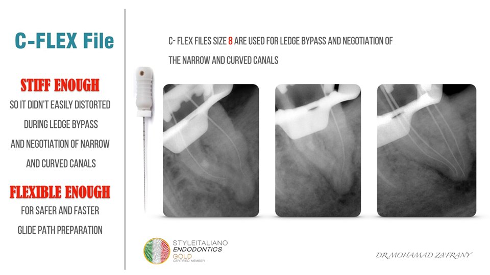 Mia75503607's tweet photo. LEDGE AND BLOCK MANAGEMENT by Mohamad ZA'FRANY.
This case is to show how selecting the right tools would affect the end result of the treatment.
#CPathRotary #AFFOne #ESparkBlue #AFRotary #VTaperGold #AFBlueRotary #AFMAX #AFCL #TlgerHandFiles https://t.co/nhOPZuCKHa