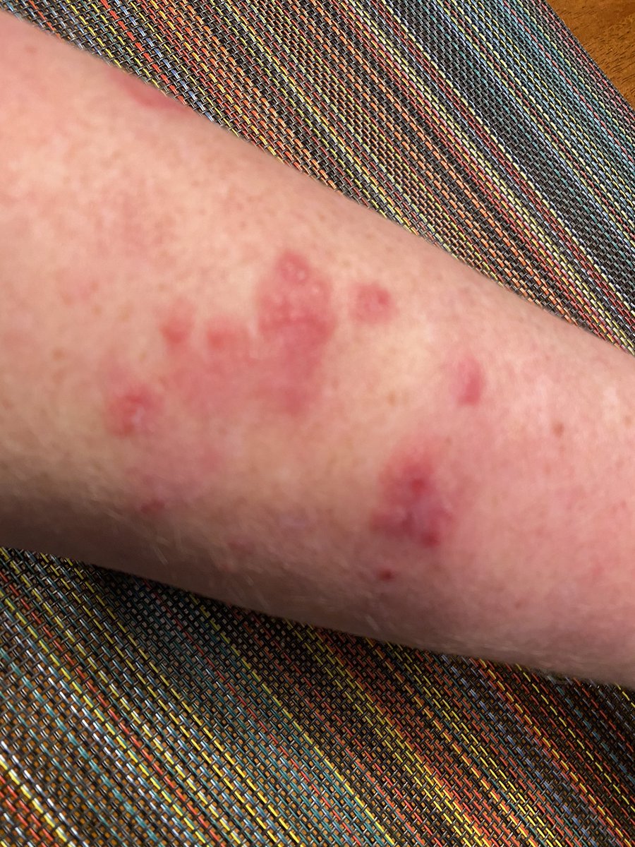 This is what happens when lupus patients have to ration hydroxychloroquine.