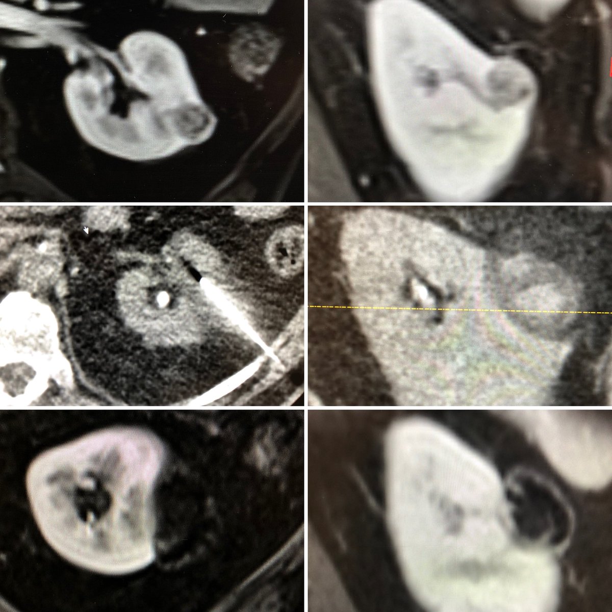 shamitsdesai's tweet photo. T1 left #RCC referred by fantastic uro. Mod sedation, 2 probe⁩ ⁦@bostonsci⁩ #VisualIce biopsy/cryo. #iceball magic. 6 mo follow up, #blackhole no residual. @AmerUrological⁩ ⁦@SIRRFS⁩; plan to follow MRI out to 5 yrs. #IRad is medical magic. https://t.co/eZM6M7SqFh