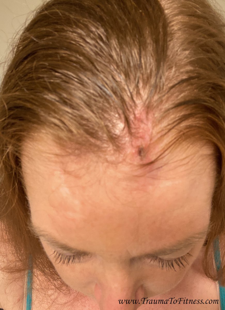 PasonActress's tweet photo. #Stitches removed this mrng.! #SkinCancer #BasalCellSkinCancer #MOHs #SkinCancerSurgery #HealthTips #StitchesInScalp #StitchesOut #Scar #Healing #Cancer #Redheads #MotivationalSpeaker #Author #Producer #Host #Consultant #Surgery #SurgeryRecovery #PasonActress #TraumaToFitness https://t.co/Va86HMd4Fo