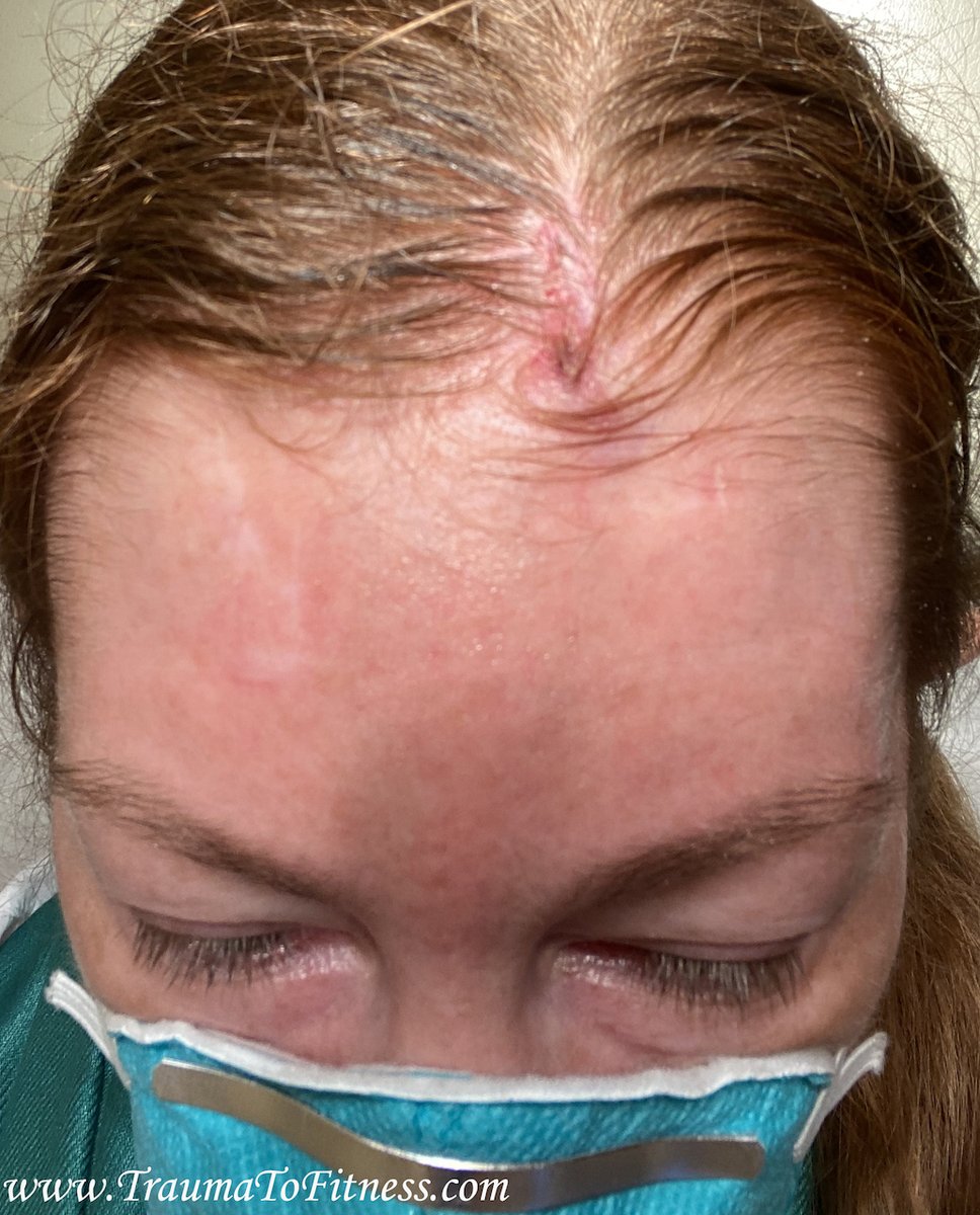 PasonActress's tweet photo. #Stitches removed this mrng.! #SkinCancer #BasalCellSkinCancer #MOHs #SkinCancerSurgery #HealthTips #StitchesInScalp #StitchesOut #Scar #Healing #Cancer #Redheads #MotivationalSpeaker #Author #Producer #Host #Consultant #Surgery #SurgeryRecovery #PasonActress #TraumaToFitness https://t.co/Va86HMd4Fo