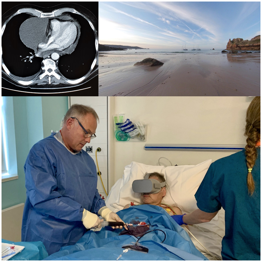Virtual reality as a therapy adjunct during emergency pericardiocentesis academic.oup.com/ehjcr/advance-… #VR #JerseyCI #cardiotwitter <a href="/TheAllanLab/">The Allan Lab</a>