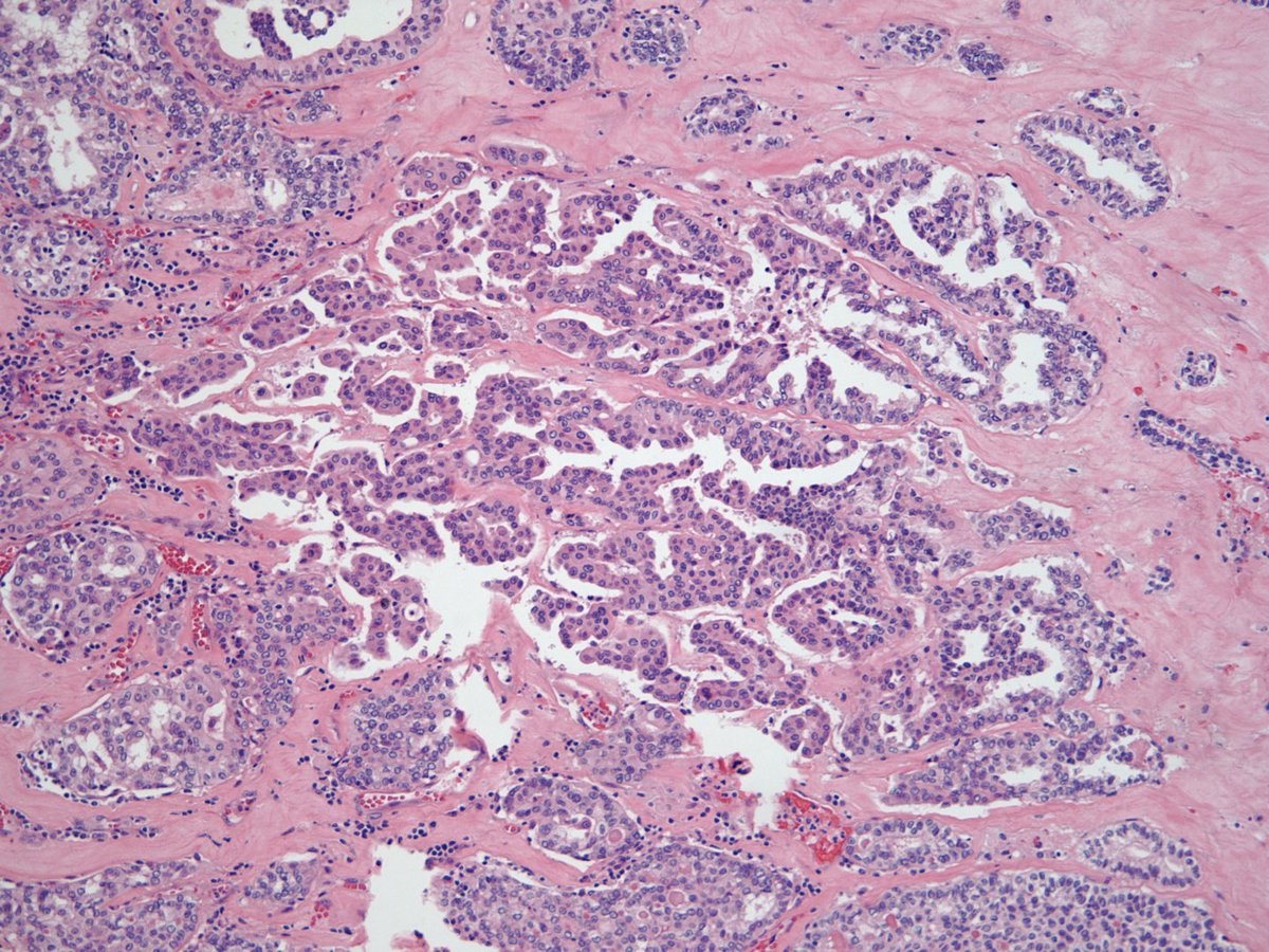 HubertLauMD's tweet photo. (3/3)🔬"Oncocytic" cells arranged mostly in a solid pattern with focal papillary architecture and classic nuclear features of PTC.

Dx: oncocytic variant of papillary thyroid carcinoma

-Uncommon variant associated with lymphocytic thyroiditis
-Similar prognosis to classical PTC https://t.co/iSxww1GJcd
