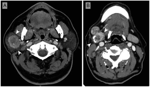 CancerCytopath's tweet image. New review article provides updates in the histology, cytology, molecular biology, and treatment of salivary duct carcinoma bit.ly/2XcmP77 #FNApath #cytopath
