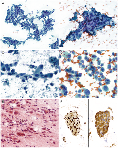 CancerCytopath's tweet image. New review article provides updates in the histology, cytology, molecular biology, and treatment of salivary duct carcinoma bit.ly/2XcmP77 #FNApath #cytopath