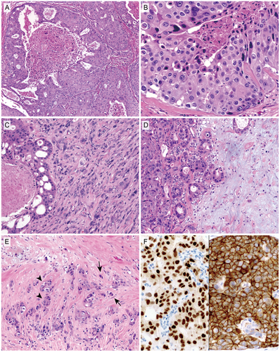 CancerCytopath's tweet image. New review article provides updates in the histology, cytology, molecular biology, and treatment of salivary duct carcinoma bit.ly/2XcmP77 #FNApath #cytopath