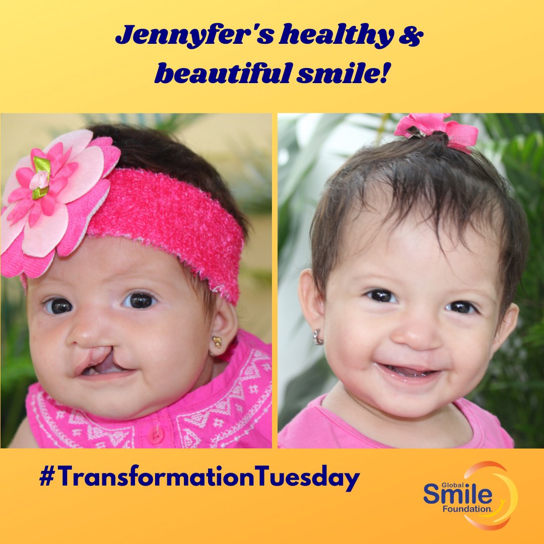 globalsmile's tweet photo. After a 2019 #cleftlip repair, Jennyfer's smile is beautiful *and* healthy! For #TransformationTuesday we are sending a virtual hug to all the parents of babies born with cleft. We believe in you! #cleftproud #cleftcutie #cleftawareness #cleftjourney #cleftmom #cleftdad https://t.co/w1V2ZBvzDb