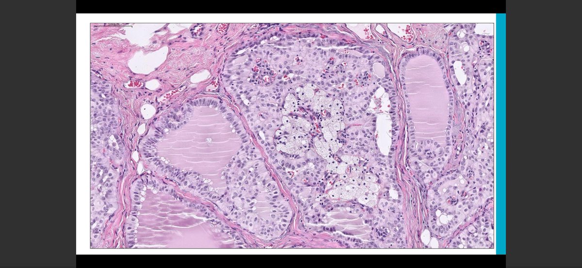 jayatidatta's tweet photo. TCCRP is ck5/6 positive &amp; typically has low grade ovoid nuclei. Can be misclassified as benign if one is not alert! IDH2 ihc is very sensitive &amp; specific for this diagnosis #newentity @CollinsLauraC #CAPVirtualPath https://t.co/sPf5blSl1h
