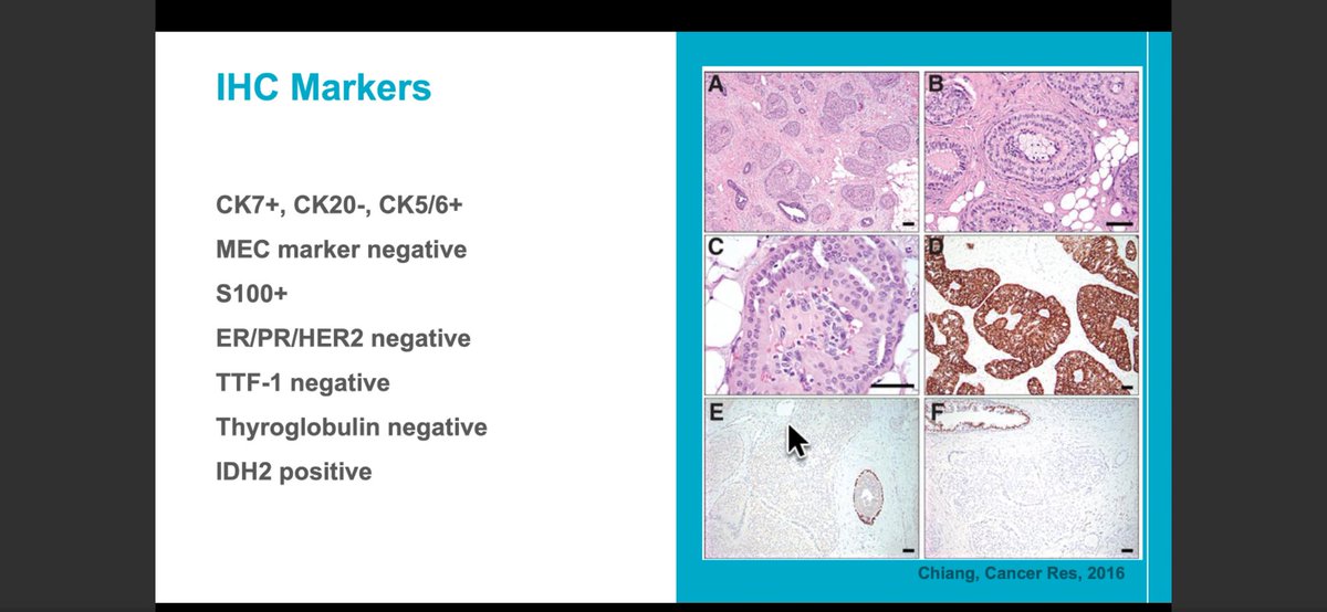 jayatidatta's tweet photo. TCCRP is ck5/6 positive &amp; typically has low grade ovoid nuclei. Can be misclassified as benign if one is not alert! IDH2 ihc is very sensitive &amp; specific for this diagnosis #newentity @CollinsLauraC #CAPVirtualPath https://t.co/sPf5blSl1h