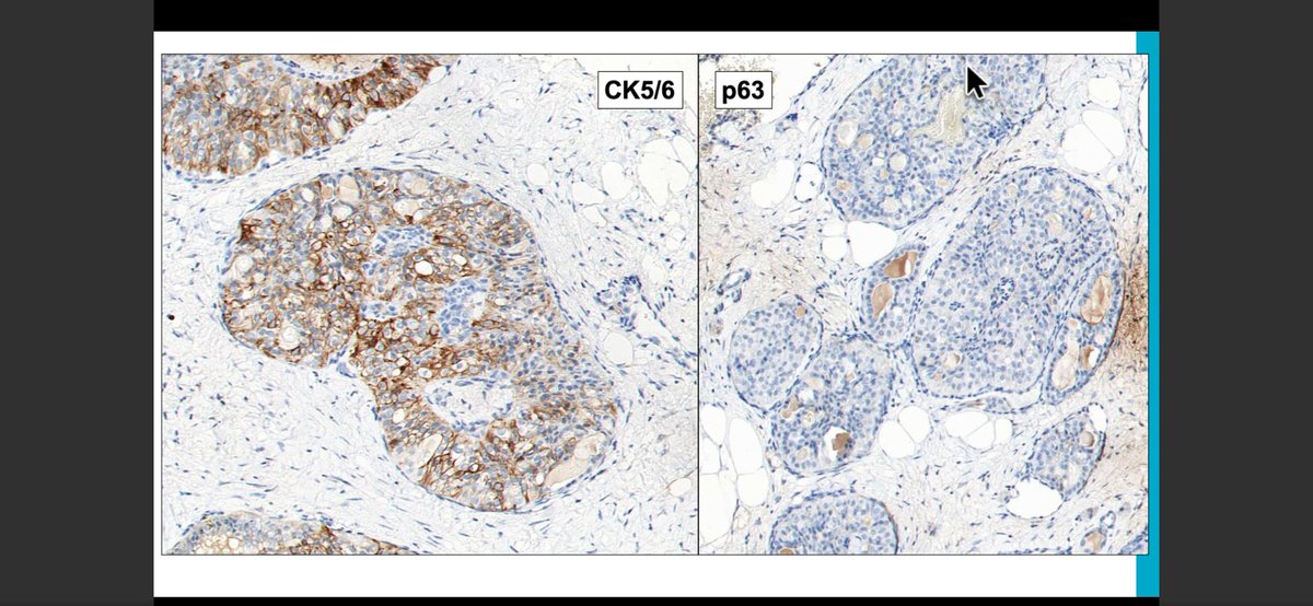 jayatidatta's tweet photo. TCCRP is ck5/6 positive &amp; typically has low grade ovoid nuclei. Can be misclassified as benign if one is not alert! IDH2 ihc is very sensitive &amp; specific for this diagnosis #newentity @CollinsLauraC #CAPVirtualPath https://t.co/sPf5blSl1h