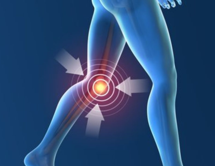 Young athletes who have undergone a partial or full meniscectomy due to a meniscus injury or prior non-treated #ACLtears have a very high chance of developing osteoarthritis later in life, which has been found to be between 65% to 90% of the time. medilink.us/e86b