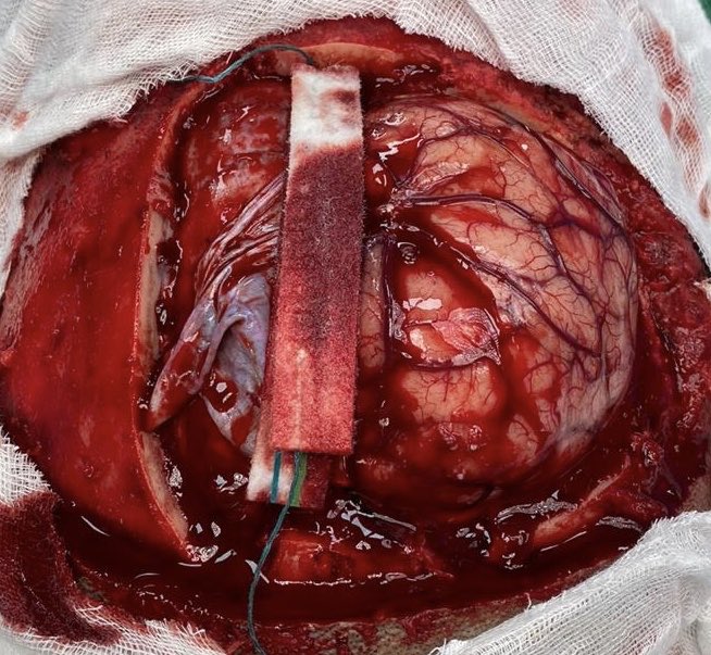jimmyachi's tweet photo. Exeresis de tumor cerebral https://t.co/e2jCekqLCJ