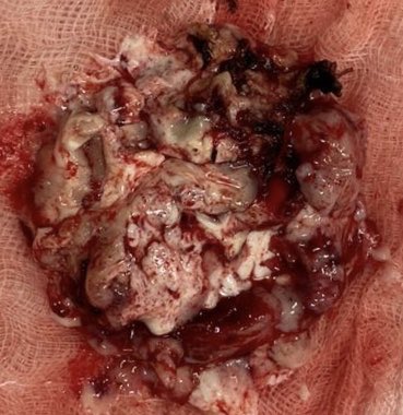 jimmyachi's tweet photo. Exeresis de tumor cerebral https://t.co/e2jCekqLCJ