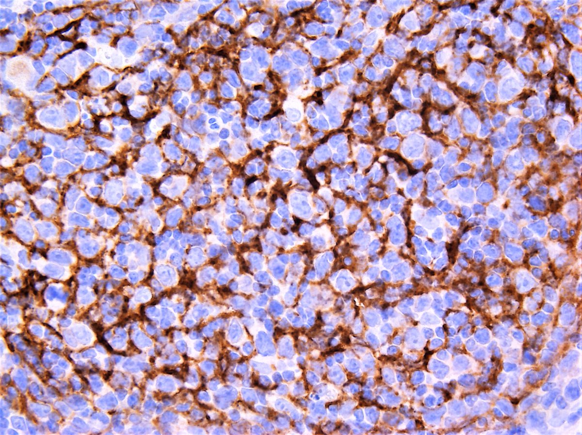 ④Immunostains of follicular lymphoma・・・CD21 #Pathology #Pathologist #hemepath
cont'd