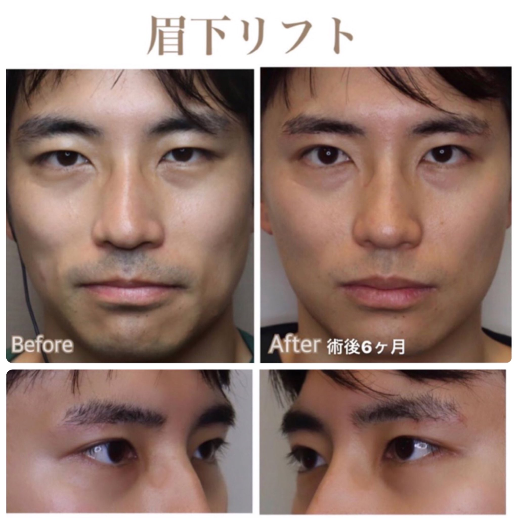 アネモネ 男性の眉下リフトの成功例 目の開きが良くなり目力がついた 眉下リフト 眉下切開 眉下リフトとは 眉毛 のすぐ下の皮膚を切除し 上に引き上げる 目に被さる皮膚がなくなる 目が大きく見える 老化で瞼が弛んでしまった場合に行われるが