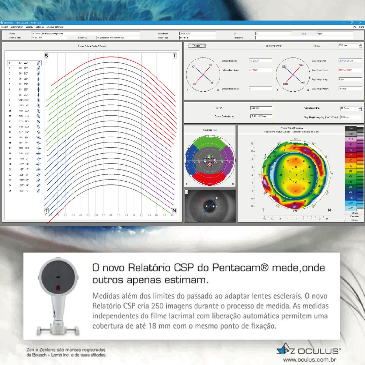 BrasilOculus's tweet photo. Você conhece os Módulos opcionais de software para o Pentacam®?
Hoje iremos apresentar o Novo Relatório CSP
Utilidade:
-Exibição das alturas sagitais da córnea e da esclera
-Perfil da esclera para encaixe da lente escleral
#Pentacam #cspreport #esclera #lentesdecontato https://t.co/Cugz7t9STz