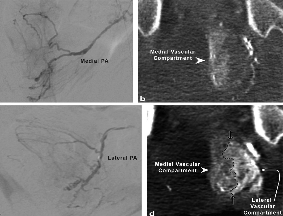 jdemeritt's tweet photo. Don’t forget CBCT during #PAE to ensure complete embolization of the central gland; a must to see separate vascular compartments, AKA type 3 central gland blood supply! https://t.co/SgIL7f4u89