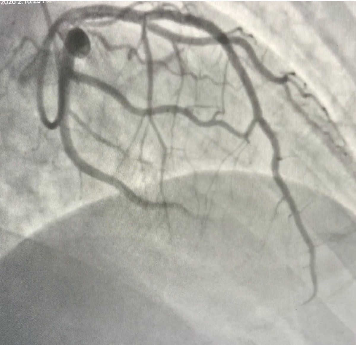 GBaqueroMD's tweet photo. Proud to have done the 1st #syncvision #IVUS coregistration on intransite during STEMI case, following restoration of flow into LAD 4 #precisionPCI in Hawaii @QueensMedical @tsethawaii @MikeTanoue @drdavidsingh #imagefirst #QMCROCKS thanks 2 #mikeosborn & our super cath team https://t.co/3qULObl5EH