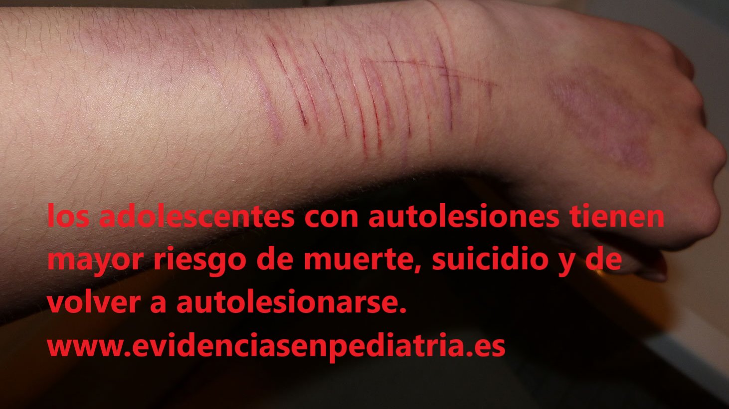ventilador Catarata Intrusión Evid Pediatría on Twitter: "Los adolescentes que se autolesionan tienen mayor riesgo de muerte y suicidio https://t.co/49Idc0I5ik https://t.co/1tRVRxZ9Sp" / Twitter ventilador Catarata Intrusión Evid Pediatría on Twitter: "Los adolescentes que se autolesionan tienen mayor riesgo de muerte y suicidio https://t.co/49Idc0I5ik https://t.co/1tRVRxZ9Sp" / Twitter