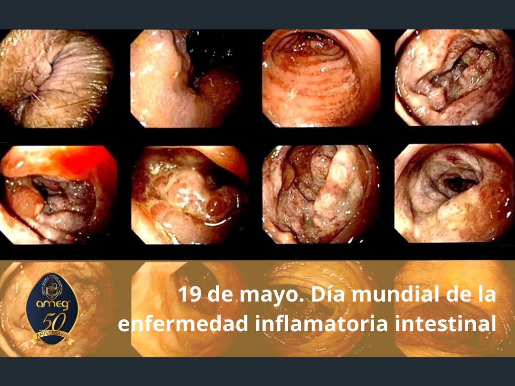 AmegMexico's tweet photo. 19 de Mayo. Día Mundial de la Enfermedad Inflamatoria Intestinal (EII). En México el pico de mayor incidencia es entre los 20 y 40 años de edad. Para el 2015 el número total de casos atendidos (prevalencia) fue: Enfermedad de Crohn en mujeres 8.1/100 000, en hombres 8.4/100 000, https://t.co/WC12Csax7M