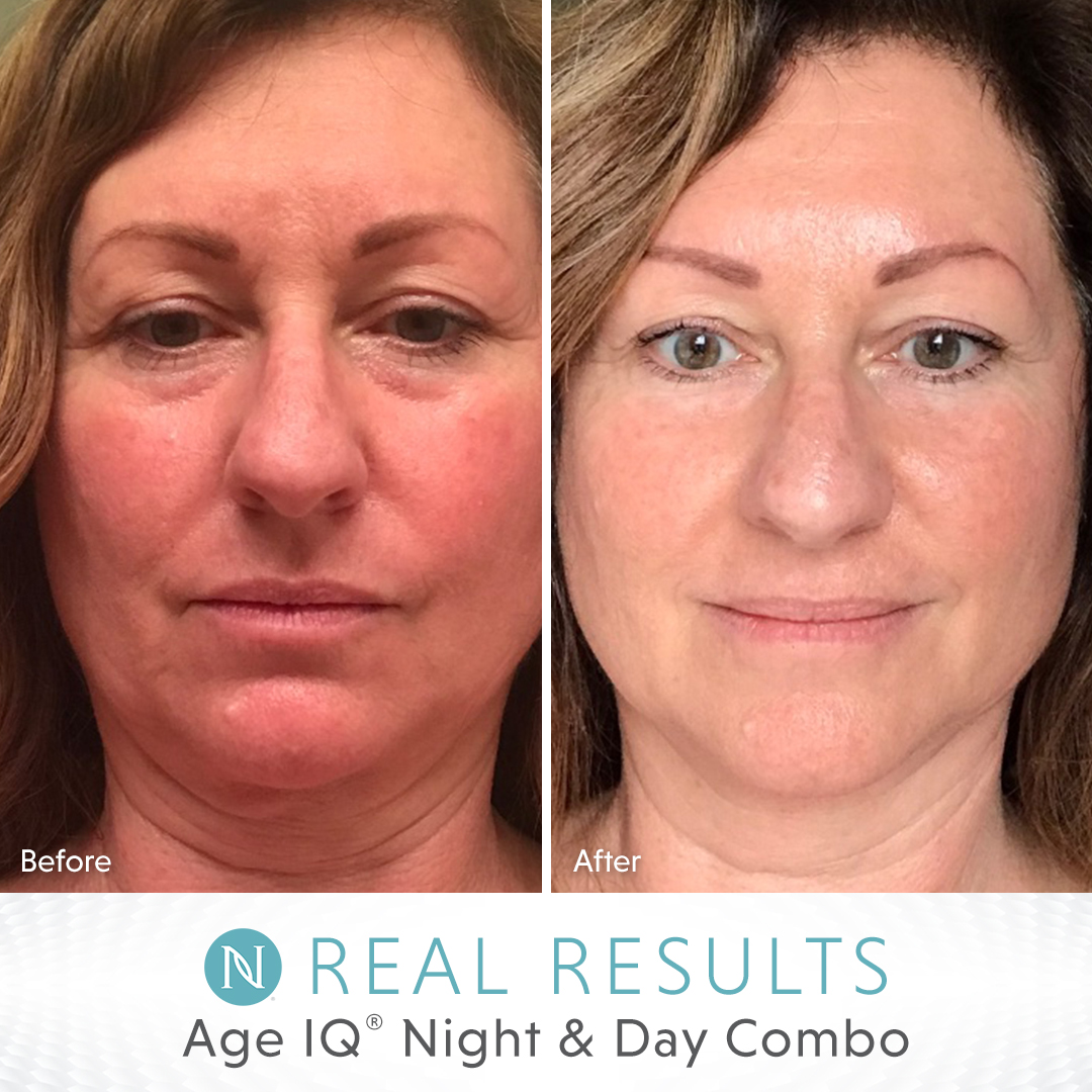 neora night cream before and after