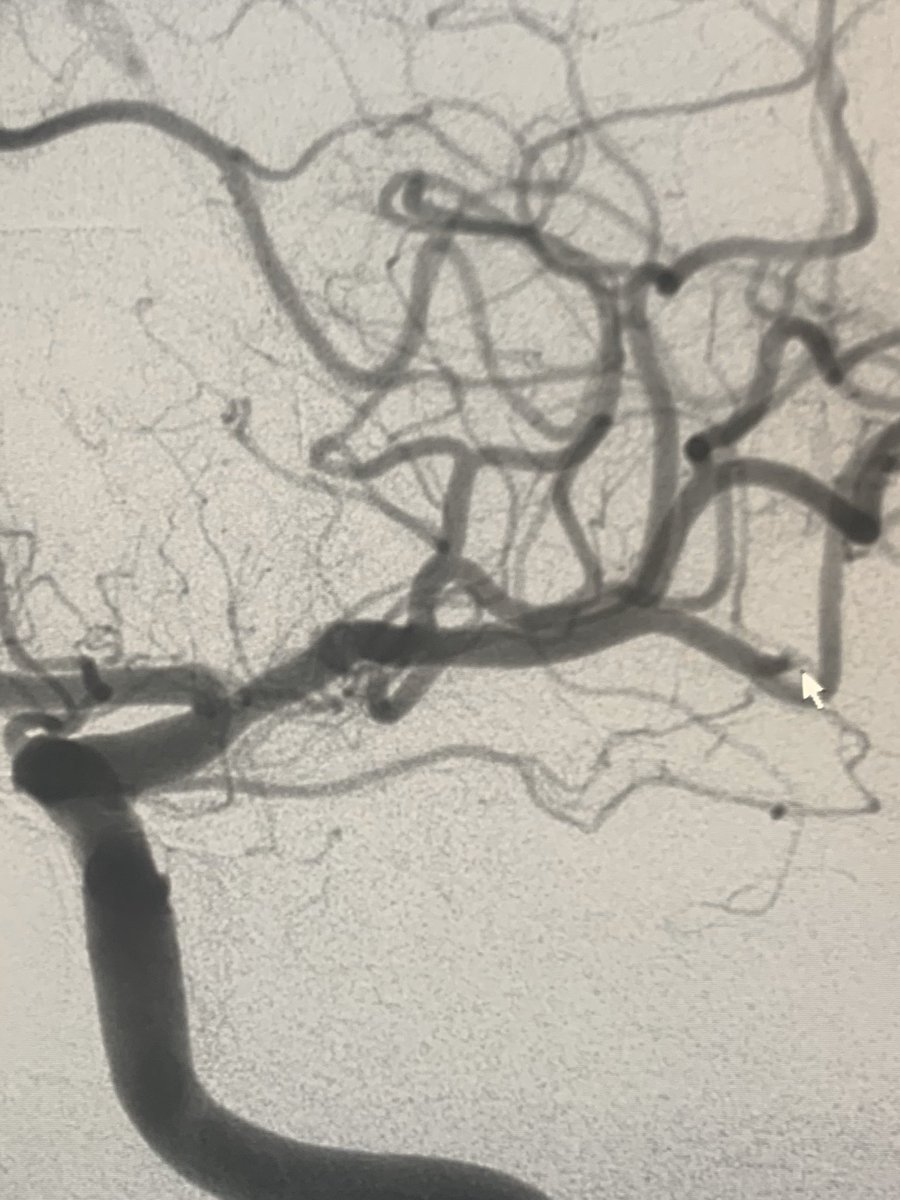 WayneOlan's tweet photo. 76 yoF (Covid Neg) with new onset R arm weakness and aphasia. NIHSS 7. 61cc mismatch. Single distal middle cerebral branch occlusion. #SmallClot #BigImpact #FirstPassOnePass #Embotrap @CERENOVUS_HQ #TICI3 #WatchTheArrow #ItsBetterOn23rdStreet https://t.co/y58TPlmRsN