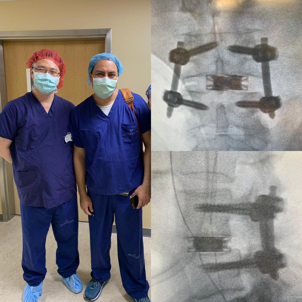 AmplifySurgical's tweet photo. First dualX cases in California Central Coast with Dr. Antulio Aroche! He performed two cases back to back in Ventura CA and both went textbook perfect. Without hesitation, Dr. Aroche told his OR staff, “I just did an ALIF without flipping the patient!” #AmplifySurgical #dualX https://t.co/GRXDoeUYT4