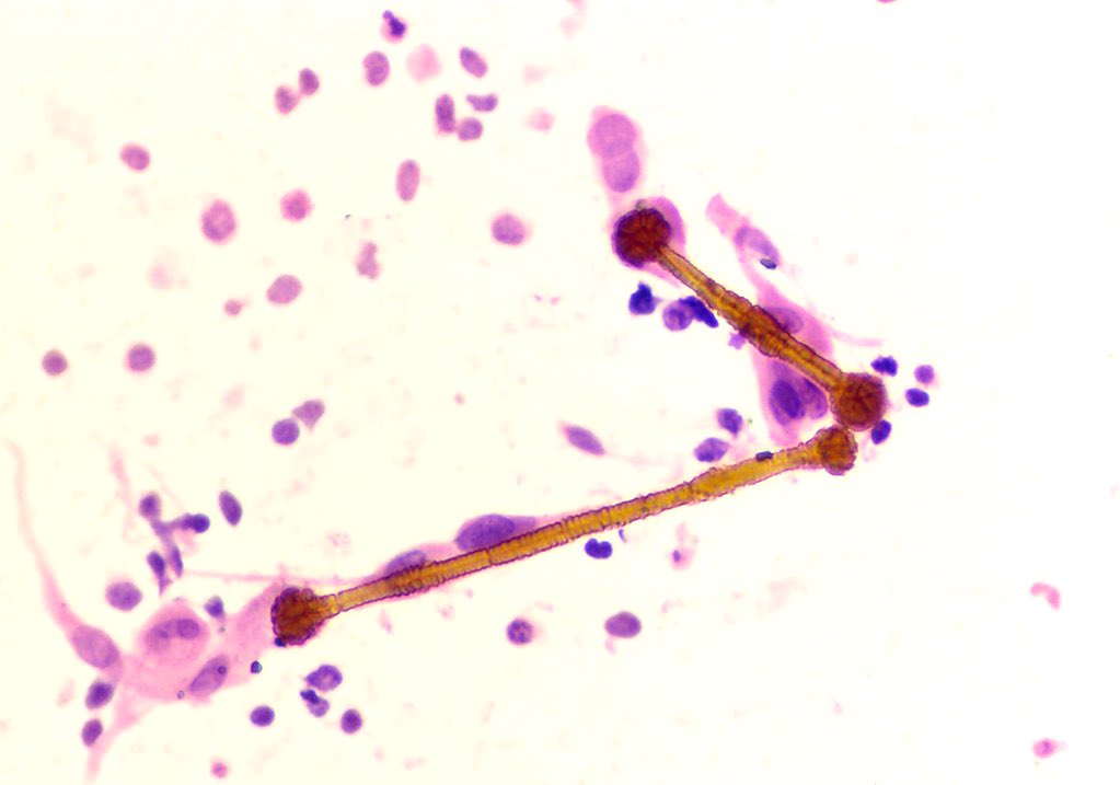 epithelioid mesothelioma chemo