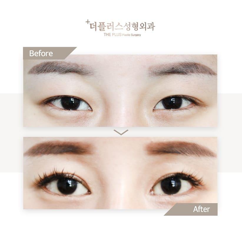theplusps's tweet image. The PLUS Plastic Surgery Blepharoplasty and Ptosis Correction Surgeries👁👁

For an online consulation, reach as at theplusps@theplusps.com
#plasticsurgery #theplusplasticsurgery #blepharoplasty #ptosis #southkorea