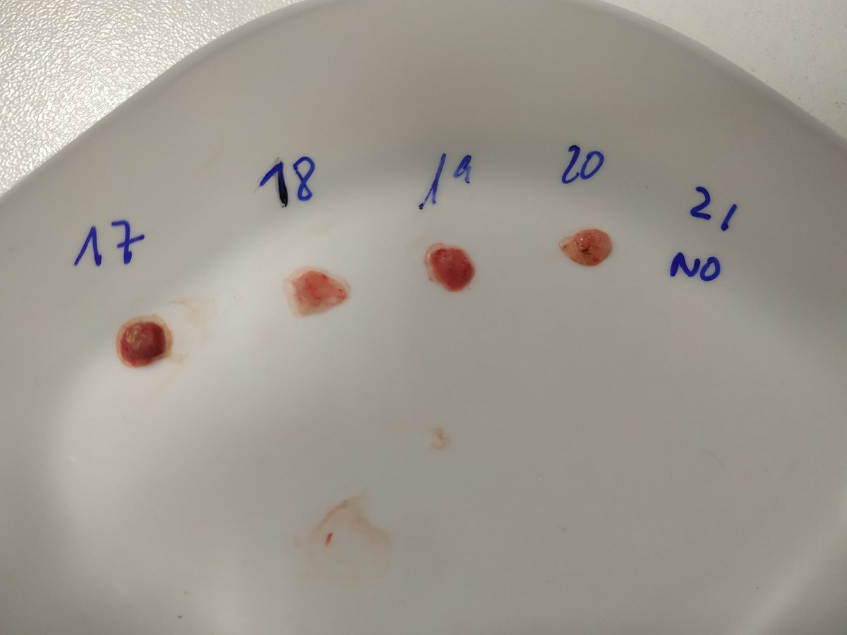 LabMerlos's tweet photo. 🔴 Optimising the chick chorioallantoic membrane xenograft model 🐣 of #neuroblastoma for novel drug delivery 💊 in @MENDELUcz and @CEITEC_Brno #czech_republic 🇨🇿
#CancerResearch
#drugdiscovery
#CAMerlosLab @CientificESenCZ https://t.co/dBXr2MEKMH