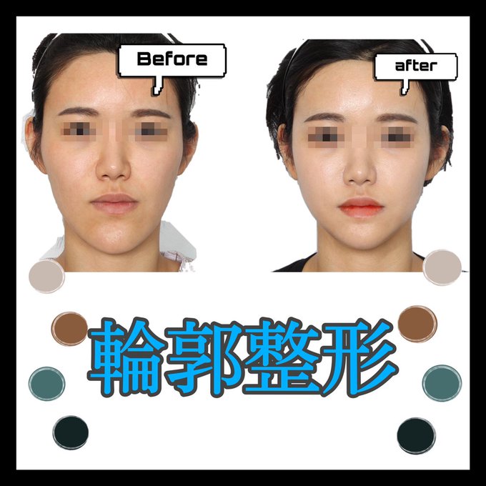 Facedesign 口ごぼ 治せます Facedesignなら何でもできる 術後の２か月 輪郭3点 顔面 輪郭 無顎 上顎 下顎 両顎 セットバック エラ削り 出っ歯 口ゴボ バッカルファット 縦幅 オトガイ 噛み合わせ しゃくれ顎 うけくち 受口 オルチャン
