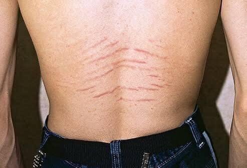 CyprusSusan's tweet photo. من هم المعرضون لـ #إسترتش_مارك #Stretch_Marks؟
الذين يستخدمون كريمات أو لوشن أو أقراص Corticosteriod
الذين فقدوا وزنهم بشكل مفاجىء خاصة النساء وخصوصاً في فترة الحمل. https://t.co/kEdTEolHjN