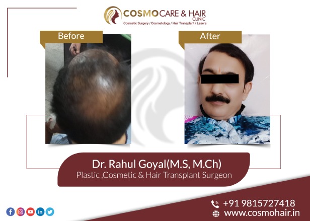 Cosmo Care  Hair Clinic  Cosmocare  Hair Clinic  Indias Leading Hair  Transplant Clinic  Best Results At Affordable Rates Sec 273  370 Sector  32 D Chandigarh Contact us
