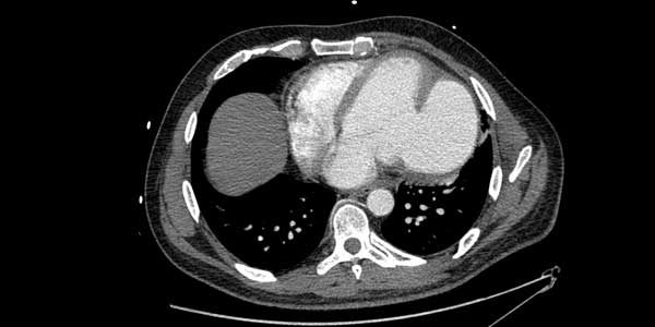 #AcuteCVDays - Free access to #AcuteCardiacCare educational content. 

This week, focus on #AcuteCoronarySyndrome with a clinical case from Dr. Santiago Montero.

Resources available for free until end of May bit.ly/2ZnIoo2

#ACVC_ESC #cvacute #cardiotwitter