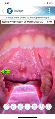 hollandhealth_'s tweet image. Our new TelScope System enables Intraoral Telehealth between patient and doctor or doctor and specialist. 

TelScope System can capture an Intraoral image and securely send that image to a doctor, dentist or specialist.