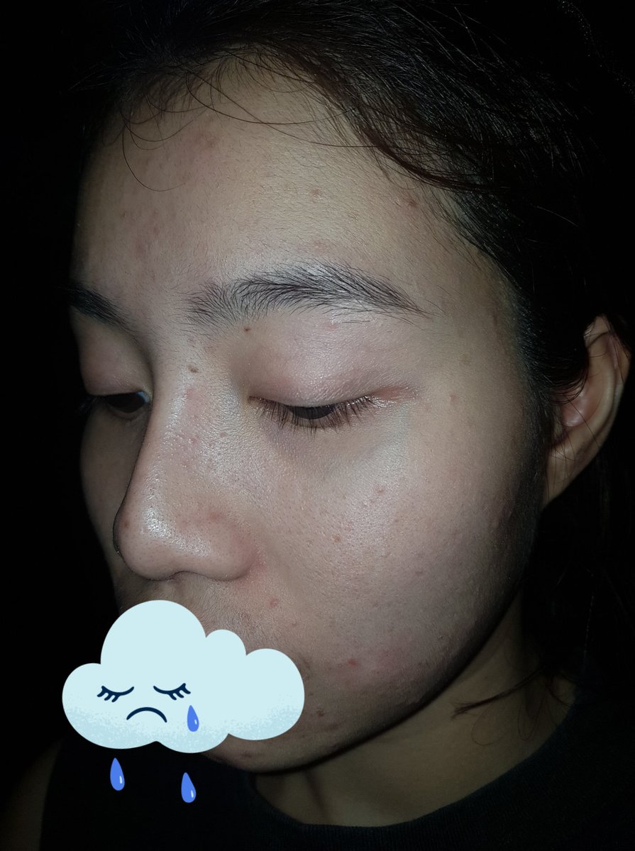 A063110's tweet photo. มาเต็มเลยจ้า รูปสามสี่เดือนที่แล้ว 
#หน้าติดสาร #สิวผด #สิวเสี้ยน #สิวอุดตัน #สิวอักเสบ https://t.co/fqwD2vTjgh