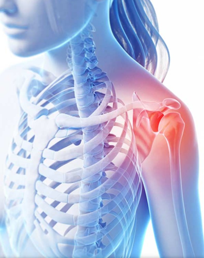bennwachukwumd's tweet photo. Is bony ingrowth better using vented PEEK anchors or solid biocomposite anchors after arthroscopic #rotatorcuff repair? Glad you asked, we have the answer. https://t.co/ugjuO7ANZS https://t.co/W6oeyAdCQY