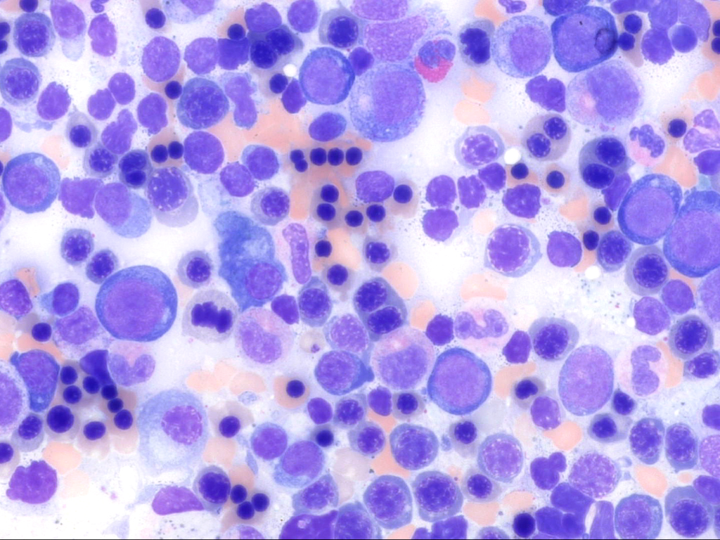 File this under "Things you haven't seen since boards" ~ Congenital dyserythropoietic anemia type 2 (CDA II) #pathology #anemia #CDA #hematopathology #hematology