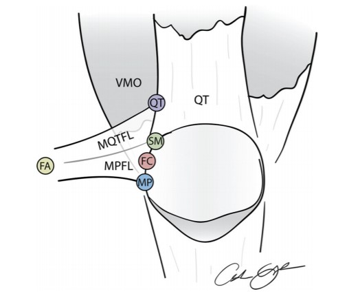 aossmjournals's tweet photo. Researchers found that ⬆️ patellar height leads to more significant changes in anisometry in the proximal MPFC attachment point as compared with the distal component. Should the MPFC be separated into 2 different anatomic entities? #patelladislocation
https://t.co/Z2Imc9bEmY https://t.co/81yoYdoBgk