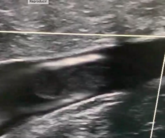 gruMAVe's tweet photo. Perfecta visualización de trombo en v. femoral común con flujo periférico que lo contornea. Video: Javier Pérez Monreal.Gracias por compartir <iframe src="https://t.co/c79n5FxG4K" height="492" width="504" frameborder="0" allowfullscreen="" title="Publicación integrada"></iframe> https://t.co/CXCh9QWGgK