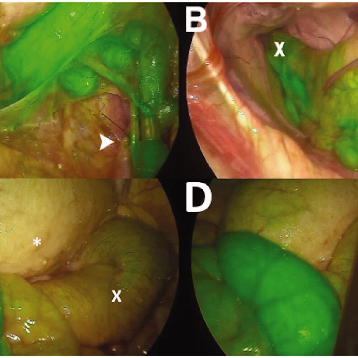 polom_karol's tweet photo. looking for proper layers Intra-arterial vs negative-staining of #embryonal resection borders with #indocyaninegreen #ICG #fluorescence for #totalmesorectalexcision in #colorectalsurgery #colorectalcancer porcine model #imageguidedsurgery @tandfonline https://t.co/tosCKECou2 https://t.co/1SZEyW3yWT