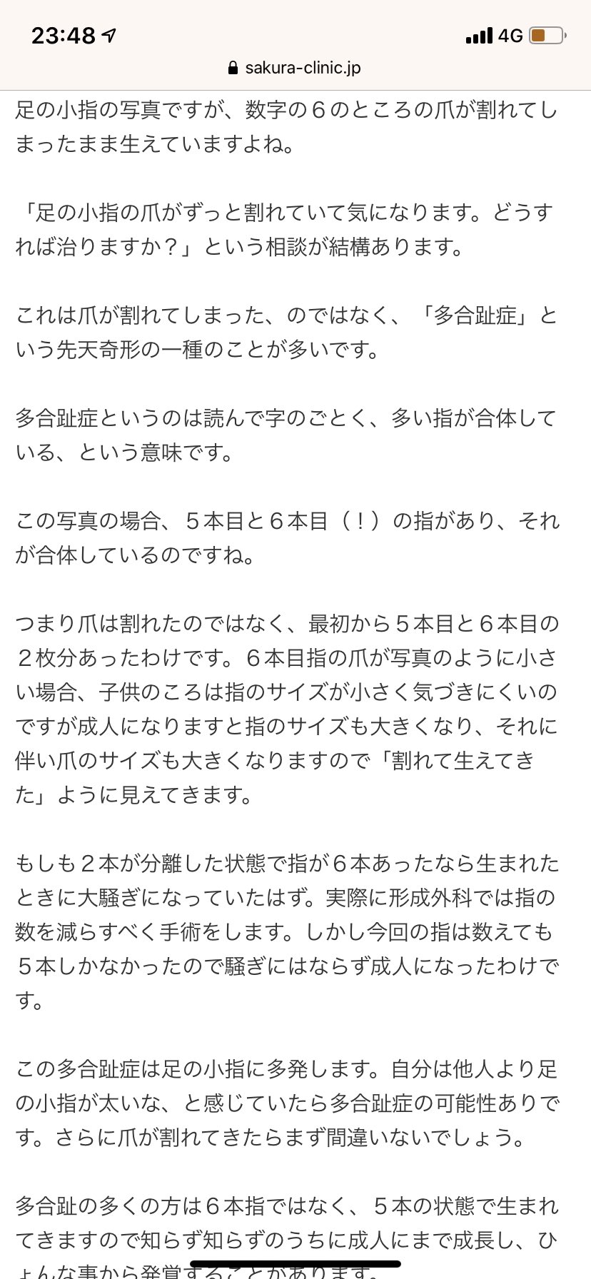 えー そうなの 両足の小指の爪の端が割れて生えている人 それは 第6の指 である可能性があるらしい 話題の画像プラス えー そうなの 両足の小指の爪の端が割れて生えている人 それは 第6の指 である可能性があるらしい 話題の画像プラス